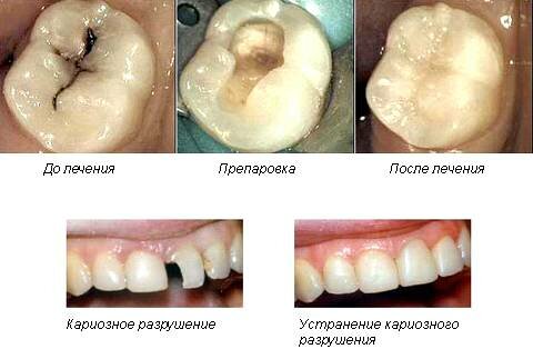 лечение зубов киев